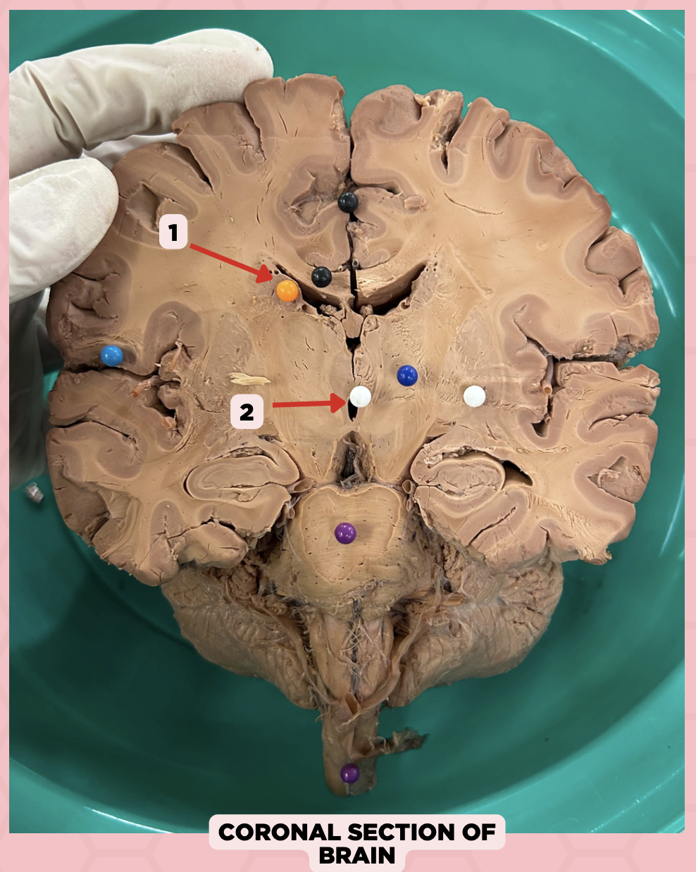 <p>What structure connects #1 and #2?</p><p>a. Cerebral aqueduct</p><p>b. Corpus callosum</p><p>c. Foramen of Monro</p><p>d. Fourth ventricle</p>