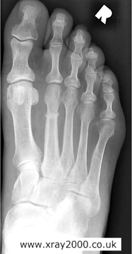 <p>stress fracture of 2nd, 3rd, or 4th MT</p><p>seen in new recruits, athletes, dancers</p>