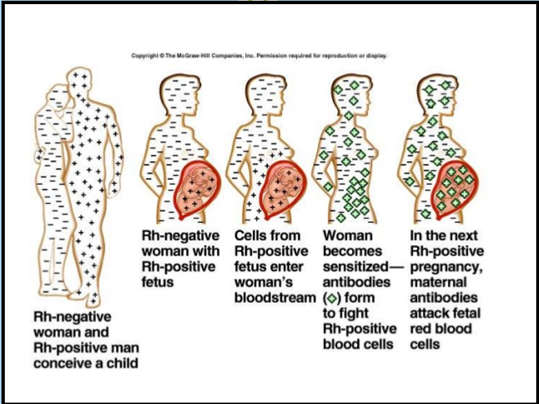 <ul><li><p>Rh-negative woman conceives with an Rh-positive man.</p></li><li><p>Rh-negative woman carries an Rh-positive fetus.</p></li><li><p>Fetal Rh-positive cells enter the mother’s bloodstream.</p></li><li><p>Mother becomes sensitized—her immune system forms antibodies against Rh-positive blood cells (mom’s body looks at it as an invader).</p></li><li><p>In the next Rh-positive pregnancy, maternal antibodies attack fetal red blood cells (so its a problem for the next pregnancy)</p></li></ul><p></p>