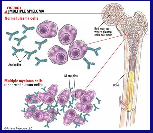 <p>-malignant plasma cells; an abnormal antibody called an “M protein”</p>