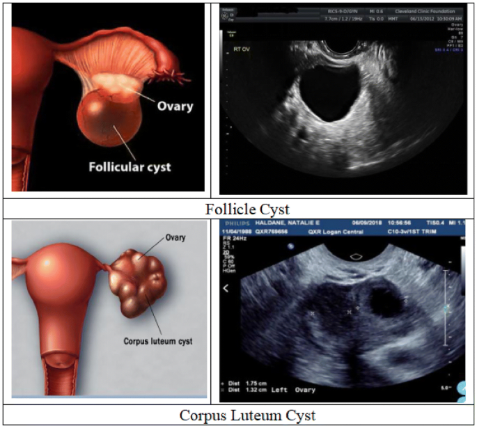 <ul><li><p>Happens when a <strong>dominant follicle fails to rupture</strong> or <strong>reseals (failed ovulation)</strong></p></li><li><p>Usually <strong>&gt;2.5 cm</strong>, typically <strong>up to 8–10 cm</strong></p></li><li><p>Simple cyst</p><ul><li><p>anechoic</p></li><li><p>clear thin walls</p></li><li><p>posterior enhancement</p><ul><li><p>asymptomatic</p></li><li><p>dull, adnexal pressure</p></li><li><p>adnexal pain</p><p></p></li></ul></li></ul></li></ul><p></p>