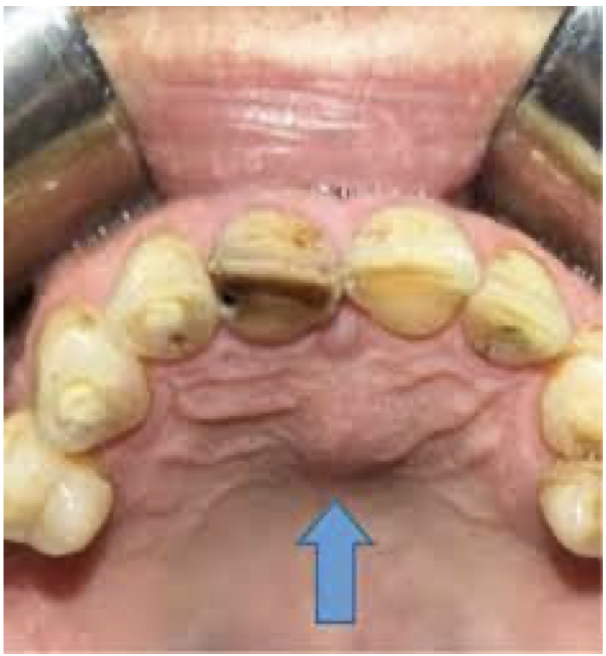 <p>32 year old male patient with complaint of swelling in midline of palate of 3 months duration. There is no pain or any other symptoms. Provide differential diagnosis and justify</p>