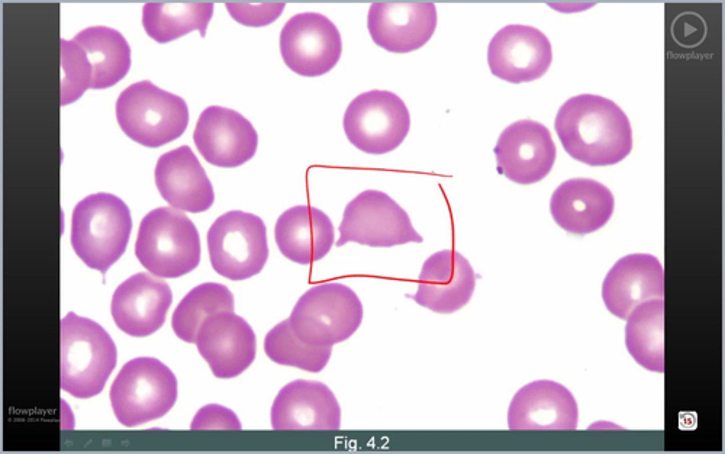 <p>what cell highlighted; seen in?</p>