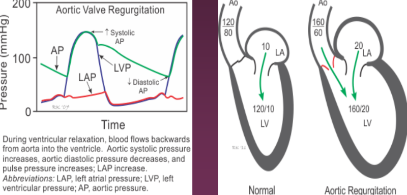<p>A decrease in aortic end diastolic pressure and an increase in LVED pressure as the AR leaves the Ao and enters the LV during diastole. Severe acute AR will present with equalization of the diastolic pressures.</p>