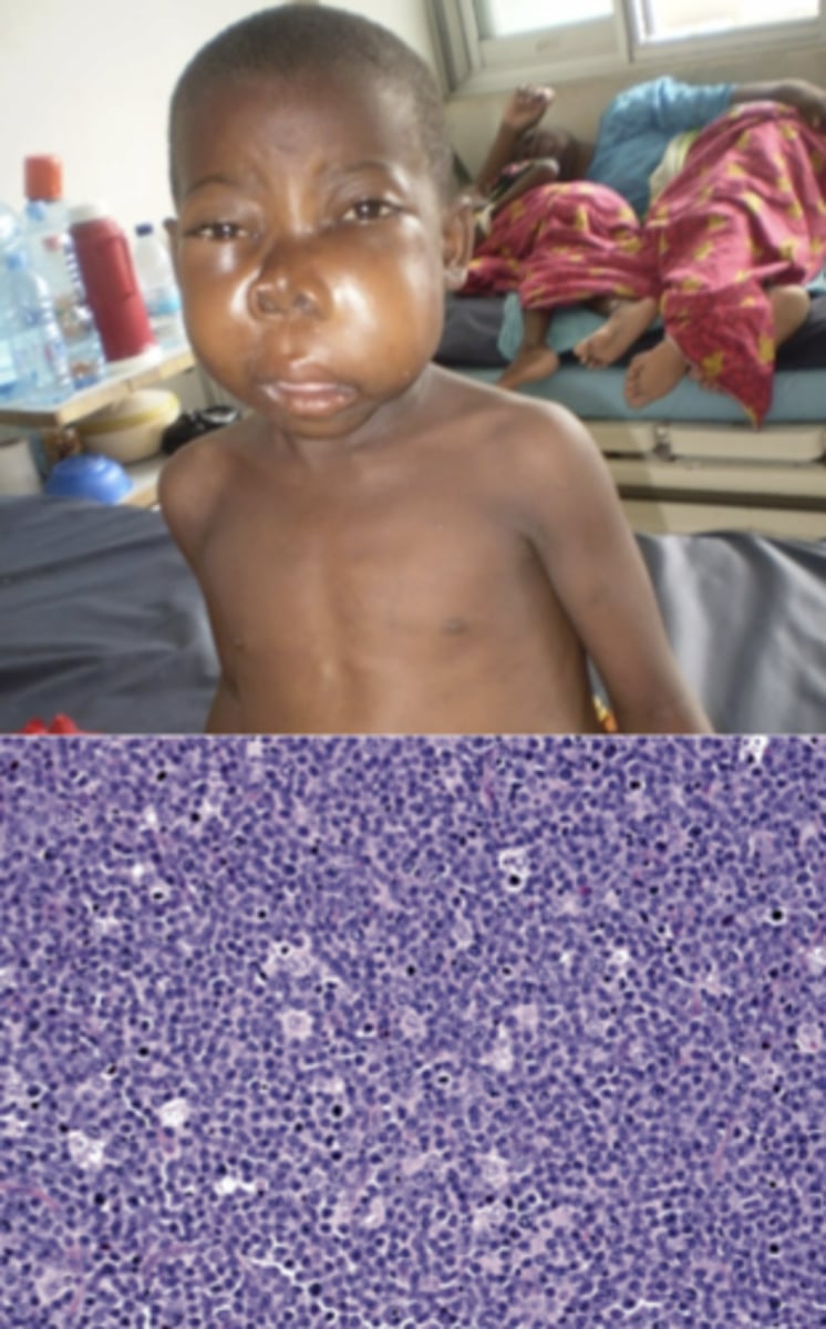 <p>burkitt lymphoma</p>
