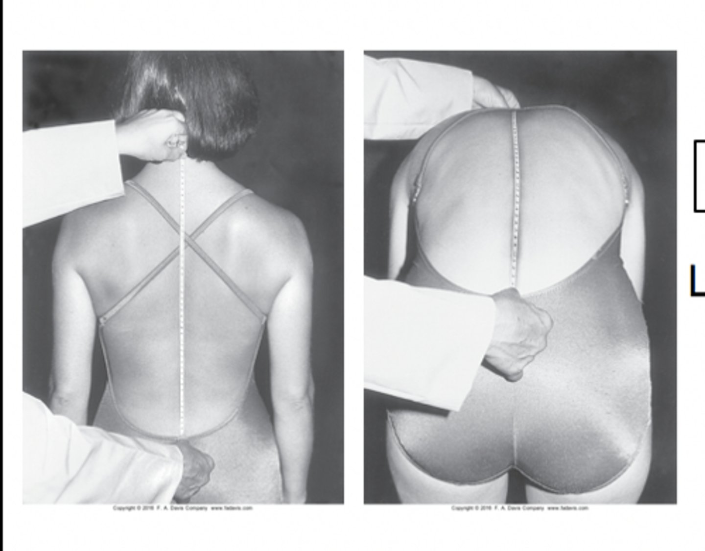 <p>spinous process T1-S2<br><br>difference of 2</p>