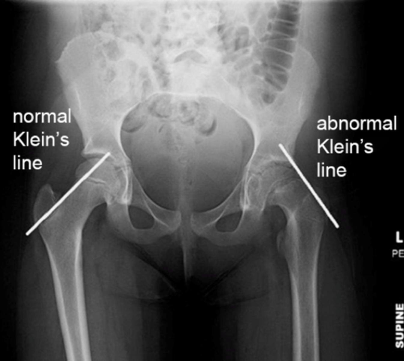 <p>AP and frog leg lateral plain films</p>