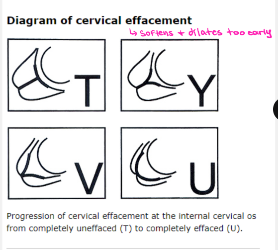 <p><strong>Cervical Insufficiency</strong></p><p>-___________ ultrasound </p><ul><li><p>Cervical length is typically _____ </p></li><li><p>Debris may be seen in the _________ fluid </p></li></ul><p>-Making the diagnosis </p><ul><li><p>Based on either a classic obstetric _______ or on a combination of obstetric history and transvaginal ___________ measurement of cervical length </p></li></ul><p></p>