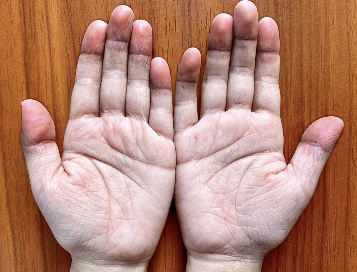 <p>anemia, low blood pressure, fear, and anger are the symptoms associated with this skin disease</p>