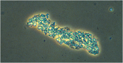 <p>-Broad, fine or coarse</p><p>-Degraded cell products and serum proteins</p><p></p><p>indicative of Renal Parenchymal Disease; ATN (acute tubular necrosis)</p>