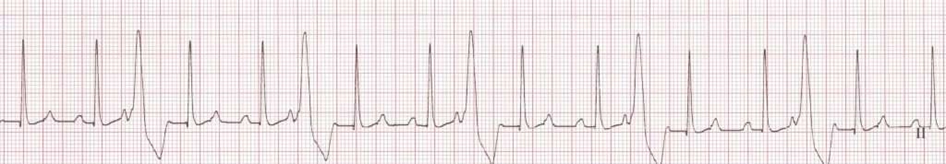 <p><span>The&nbsp;______&nbsp;arrhythmia is characterized by wide and bizarre QRS complexes without a P wave. There are different types of this arrhythmia which include unifocal, multifocal, and runs. Please name the arrhythmia.&nbsp;</span></p>