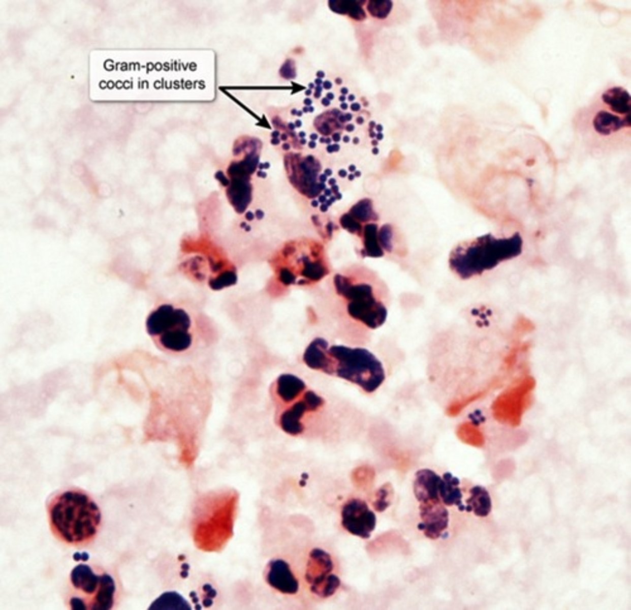 <p>Gram "+" in clusters</p><p>β-Hemolytic</p><p>Catalase "+"</p><p>Coagulase "+"</p><p>Risk Factors</p><p>-IV Drug use </p><p>-Intravascular Catheters (For Nocosomial infections)</p><p>Virulence Factors</p><p>-Exfoliative Toxin A (Protease which targets Desmoglein in Bullous Impetigo)</p><p>-Preformed Enterotoxin</p>
