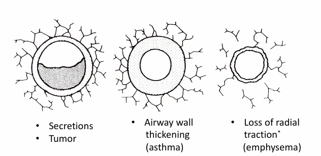<p>-increases resistance to flow</p><p>-any reduction in the lumen of an airway will increase resistance to flow exponentially (r^4)</p>