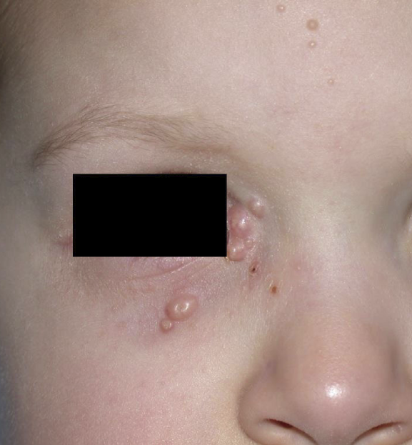 <p>firm, domed papule with central umbilication</p>