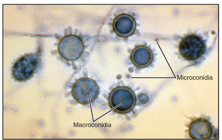 <ul><li><p>respiratory fungal disease</p></li><li><p>cause: <em>Histoplasma capsulatum</em></p><ul><li><p>found in central and eastern US soil</p></li><li><p>virulence: replicate within macrophages, opportunistic</p></li></ul></li><li><p>transmission: inhalation of soil spores</p></li><li><p>symptoms: mild and localized within lungs</p><ul><li><p>immunocompromised → suffer severe disease</p></li></ul></li></ul><p></p>