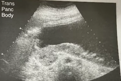 <p>A 55 year old, moderately obese woman w/previous cholelithiasis returns to her Dr. for a 6 month f/u exam after cholecystectomy. She now has mild to moderate, intermittent epigastric pain and occasional fever. Sonographic results show choledocholithiasis, a dilated pancreatic duct, and a fluid collection anterior to the tail of the pancreas. What is the cause for the sonographic findings?</p>