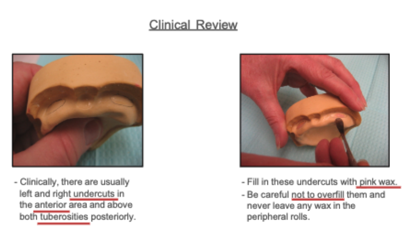 <ul><li><p>maxillary → anterior area and above both tuberosities posteriorly</p></li><li><p>mandibular → labial aspect and both retromylohyoid areas</p></li></ul><p>fill in these undercuts with pink wax (careful not to overfill and never leave wax in peripheral rolls)</p>