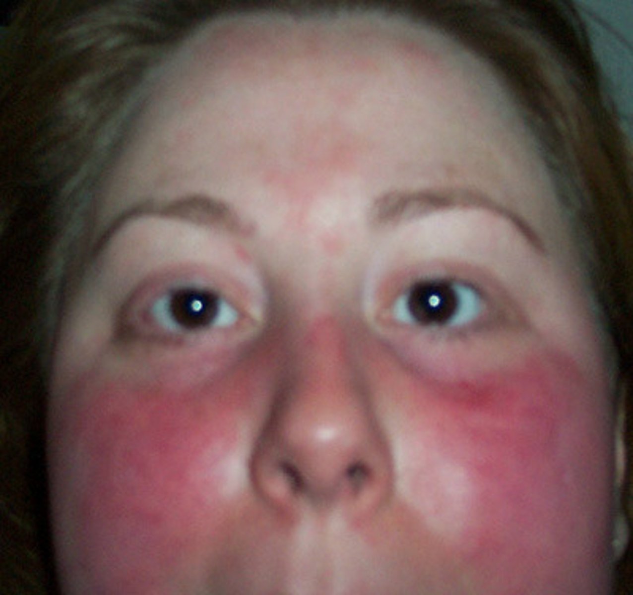 <p>diffuse redness of the face or another area of the body</p>