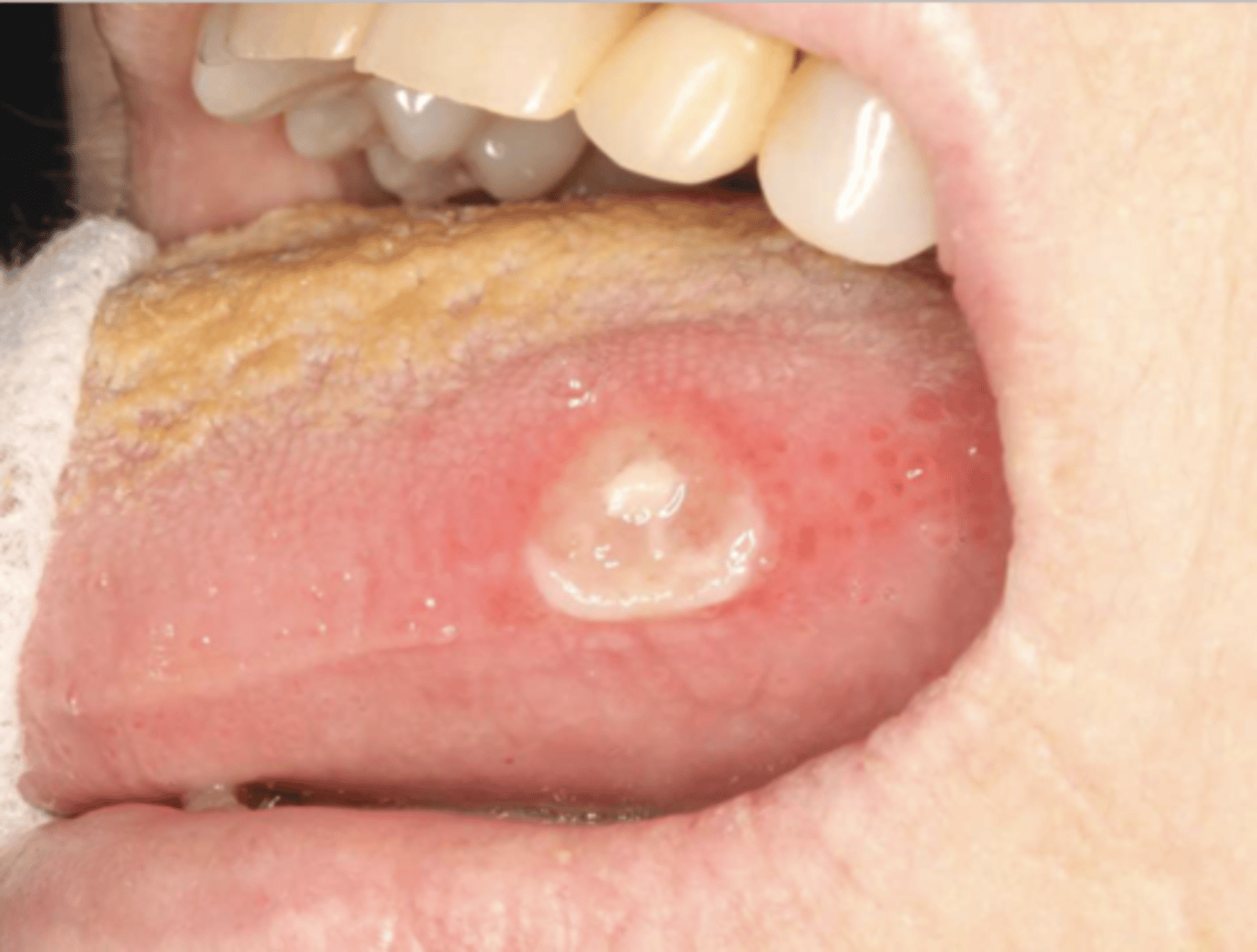 <p>Patient reported that they bit the side of their tongue. What do you suspect?</p>