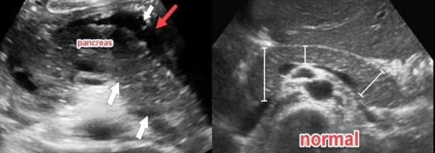 <p>What is the red arrow pointing to? Which pancreatic pathology is this sonographic finding associated with?</p>