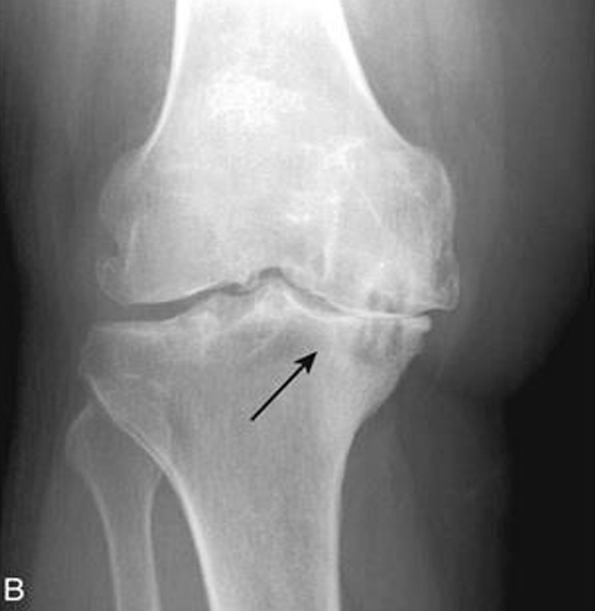 <p>What pathology is seen here?</p>