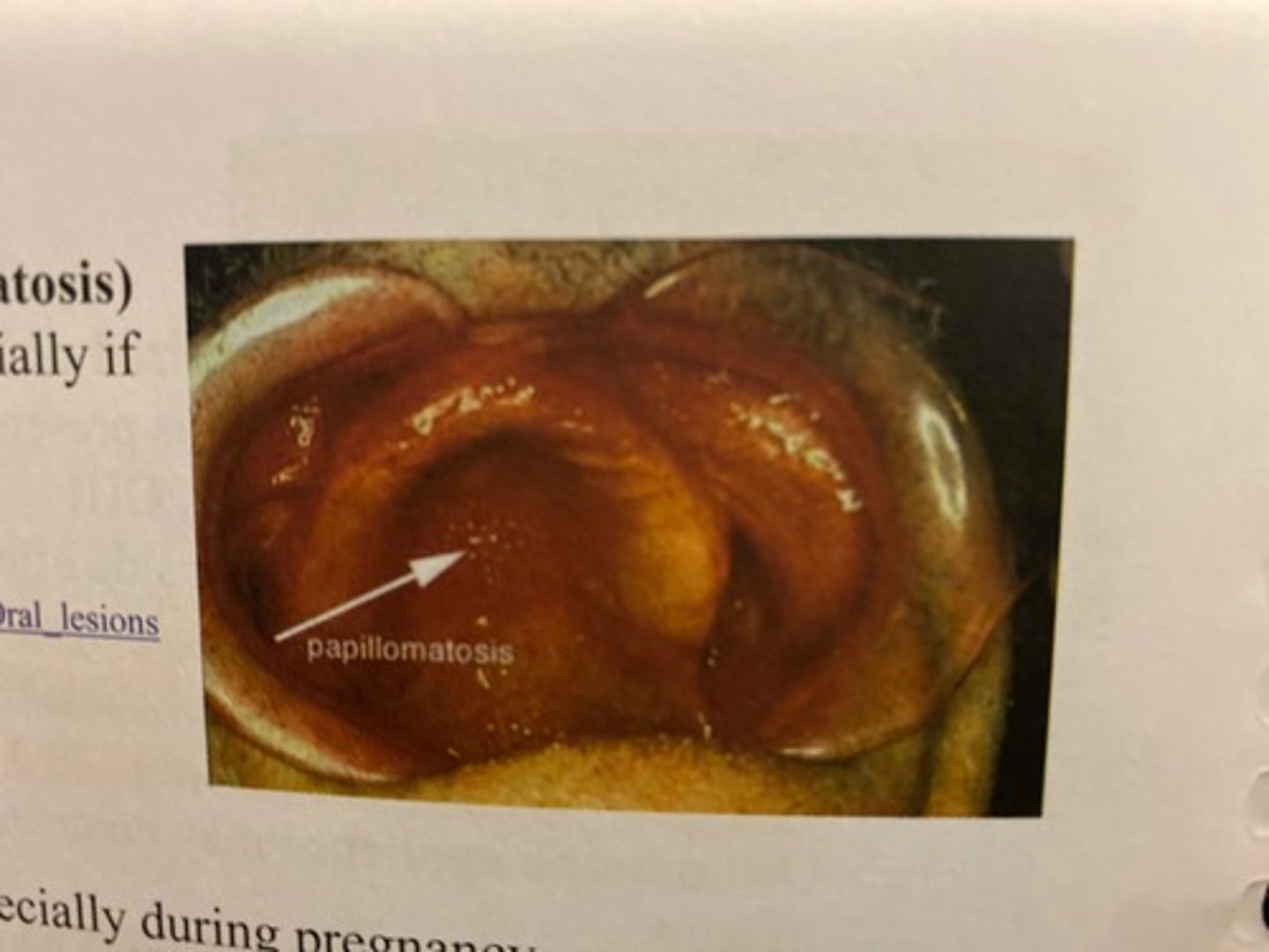 <p>Papillary lesion under maxillary denture, especially if denture never removed.</p><p>Excise tissue and remove denture.</p>