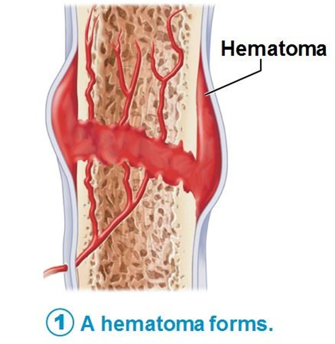 <p>a solid swelling of clotted blood within the tissues.</p>