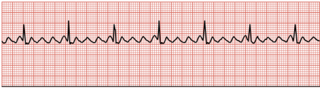 <p>Single area within the atrial tissue firing faster than the ventricles are responding, resulting in multiple flutter waves for each QRS complex.</p>