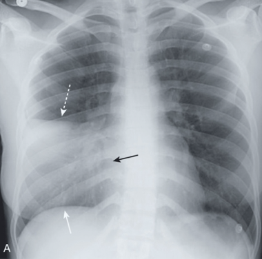 <p><span><mark data-color="yellow" style="background-color: yellow; color: inherit">Fever, cough, tachypnea, tachycardia, asymmetric ↑ tactile fremitus (vibration), dullness on percussion, consolidation on chest x-ray film</mark> (see picture attached)</span></p>