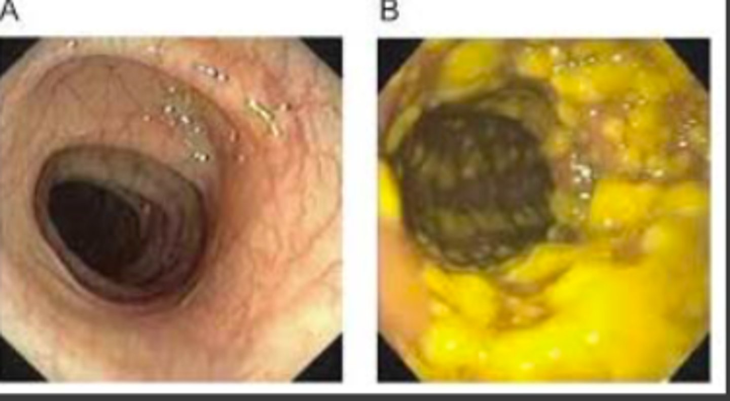 <p>A: regular</p><p>B: pseudomembranous colitis</p>