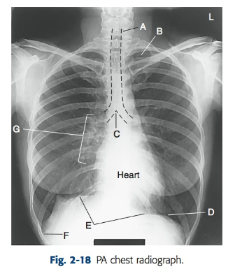 <p>(F) The most inferior and lateral parts of the lung where the diaphragm meets the ribs; important for detecting fluid.</p>