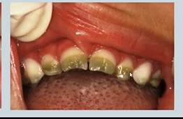 <p>abnormal colour of teeth - what causes olive green teeth?</p>