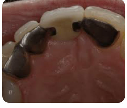 <p>The new design of the wing is perforation free, and the retention to the resin could obtained by producing microspaces in the wing (retainer) internal surface through various ways such as electrochemical pit corroding technique (metal etching) </p>