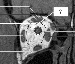 <p>within the “cone” created by the extraocular muscles</p>