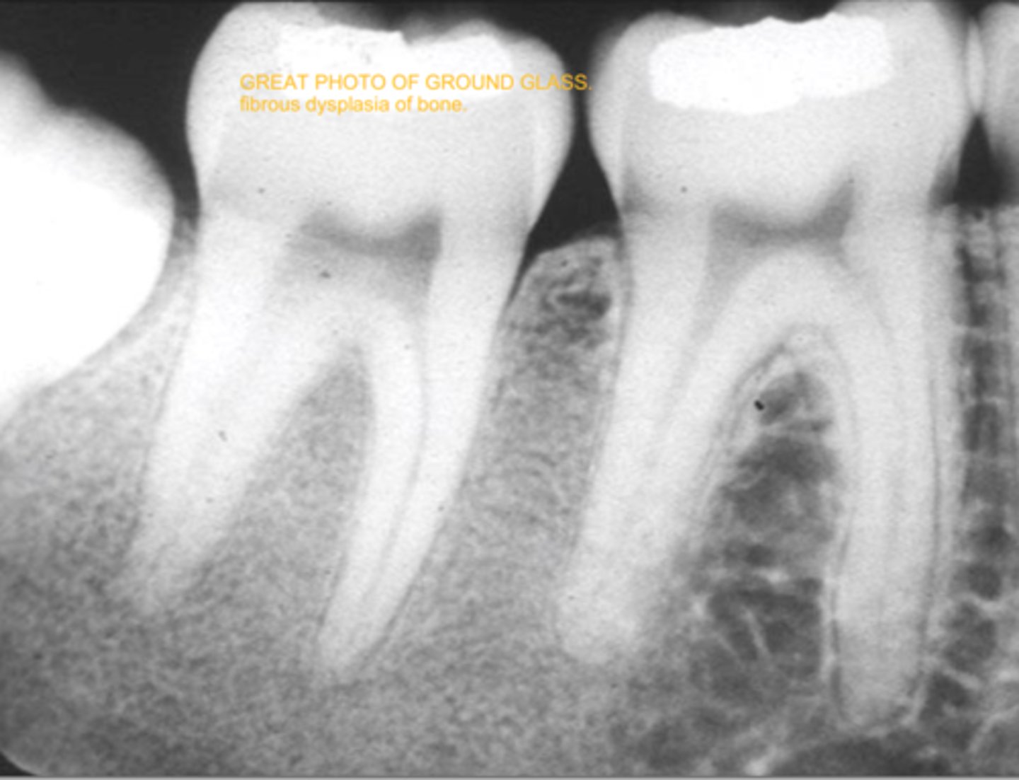 <p>cause: unknown</p><p>clinical features: painless gradual enlargment of bone replaced by fibrous CT (paget's is gradual enlargement presenting w pain)</p><p>oral features: maxilla is affected (like paget's); bone expansion/displacement</p><p>radiographic: ground glass/orange peel appearance</p><p>prognosis: guarded bc of 25-50% recurrence</p><p>population: teens/YA <20s</p>