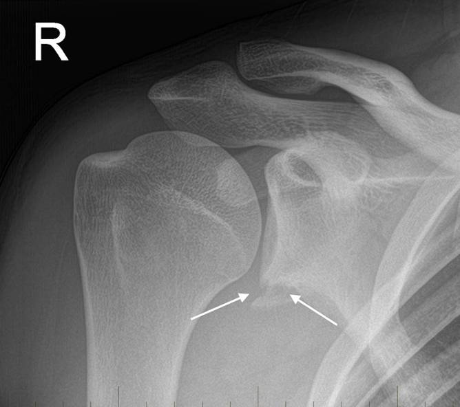 <p>what projection best demonstrates a bankarts lesion&nbsp;</p>