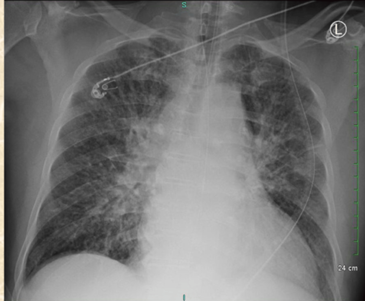<p>What does this CXR show?</p>