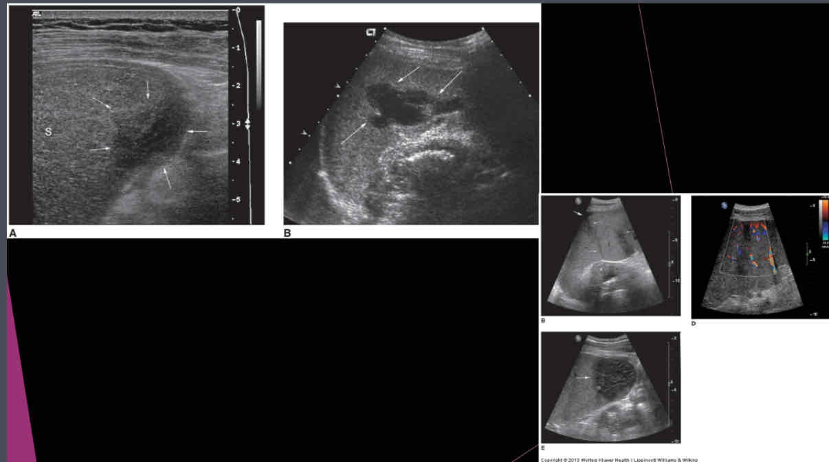 <p>US appearance of intraperitoneal blood depends on what?</p>