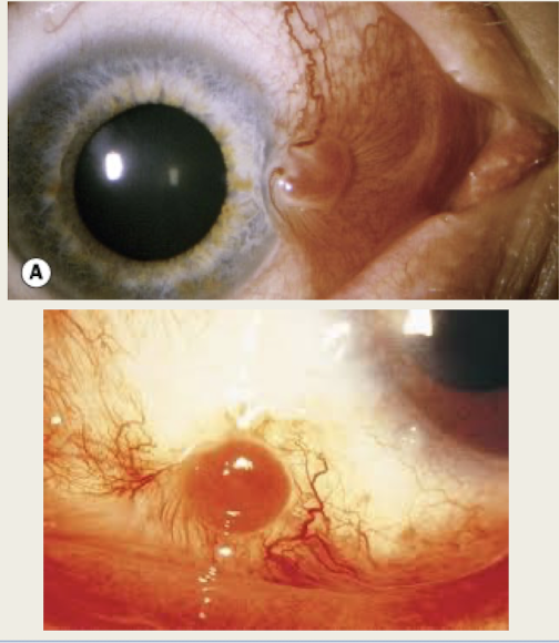 <p>fibrovascular lesion formed due to surgery or injury</p>