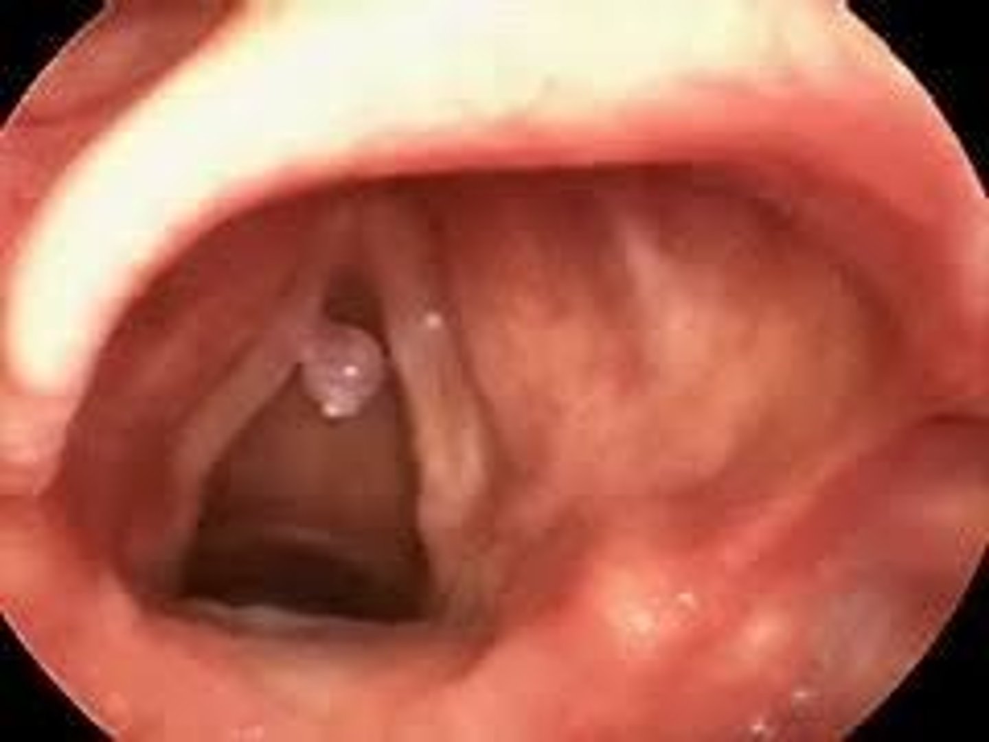 <p>Fluid-filled lesions on the vocal folds, larger than nodules and can be unilateral or bilateral.</p>
