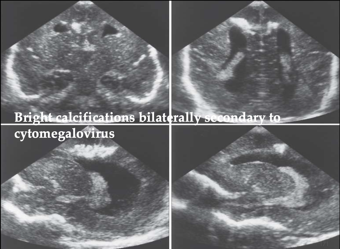 <p>What pathology is being shown?</p>