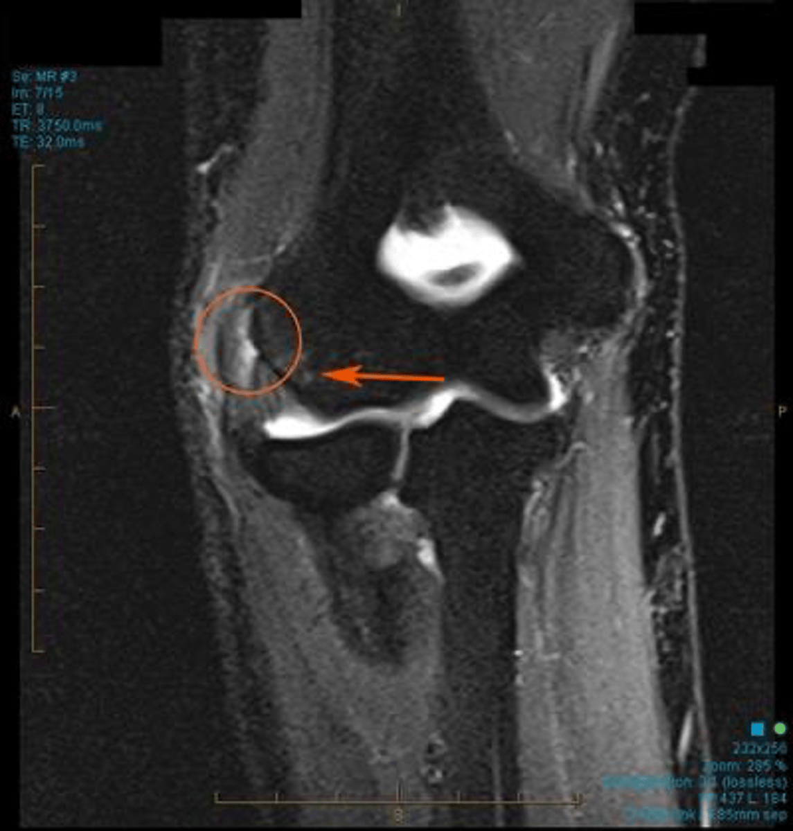<p>X-ray: Most likely normal</p><p>MRI... No need for MRI</p><p>•MRI changes often present in sx patients</p><p>•Increased signal intensity at ECRB tendon may be seen (50% of cases)</p><p>imaging not great for tennis elbow</p>