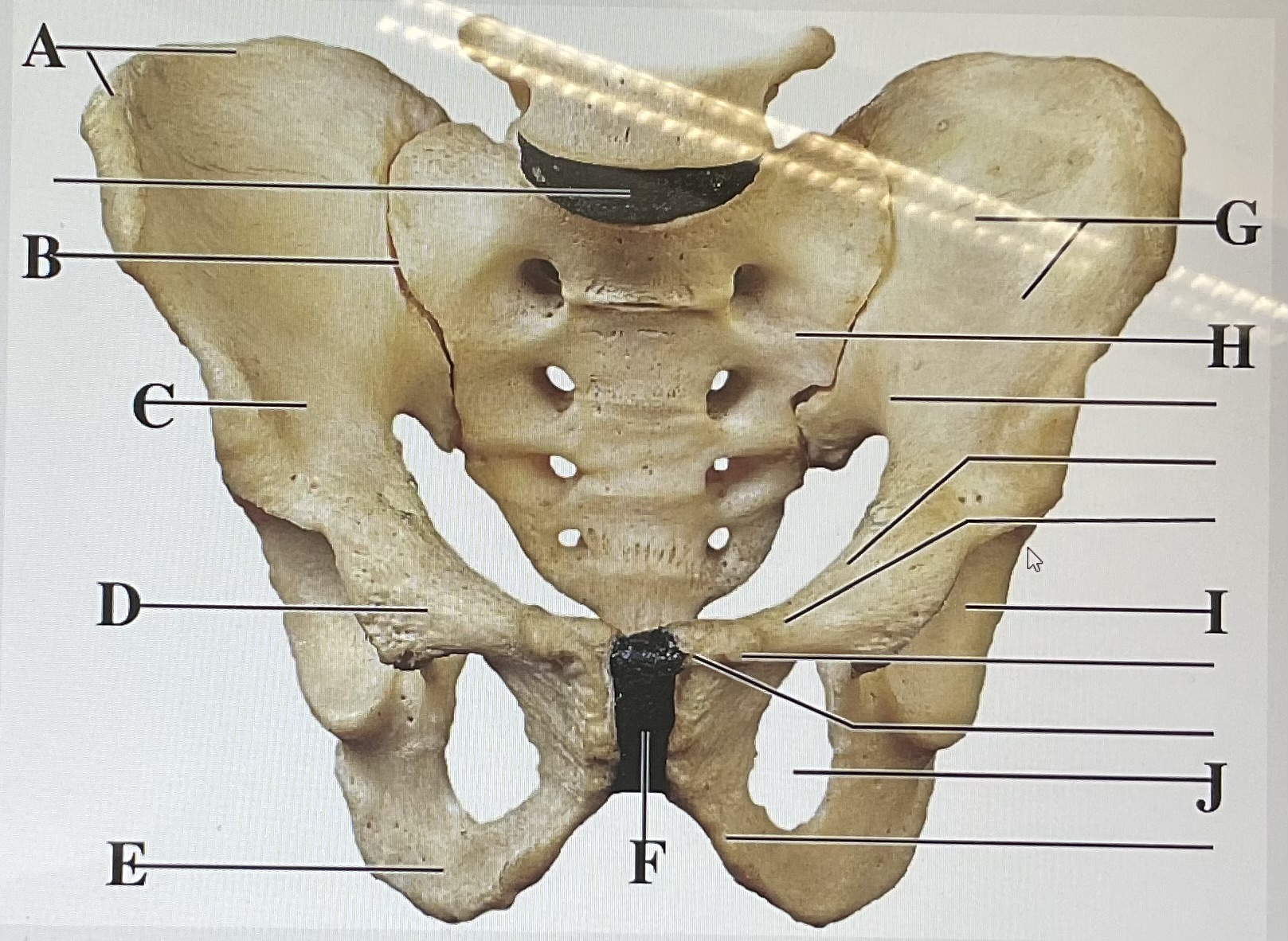 <p>in the figure above letter ___ is the pubic symphysis and letter __ is the ischium</p>