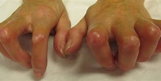 <p>from <span style="color: #321ed2"><strong>comorbidities</strong></span></p><ol><li><p><span style="color: #df22de">Scleroderma </span>(tightening of skin)</p></li><li><p><span style="color: #e63030">Lupus</span></p></li><li><p><span style="color: #167d56">RA</span></p></li><li><p><span style="color: #c028dd">Arterial </span>disease</p></li><li><p><span style="color: #e38f03">Carpal Tunnel Syndrome</span></p></li></ol><p></p>