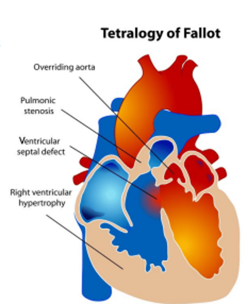 <p>Ventricular septal defect with overriding aorta. It starts as a right to left shunt and the pulmonic valve is highly resistant due to stenosis. The aorta provides an escape route to the blood that can't exit thru the pulmonic valve</p>