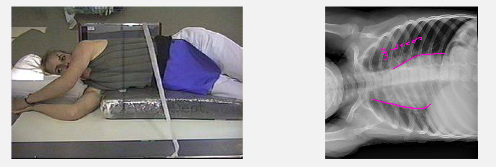 <p>Patient who is lying down, with the central ray horizontal. Taken front to back. Useful when looking for abnormal fluid or air collections. Air rises, fluid falls. </p>