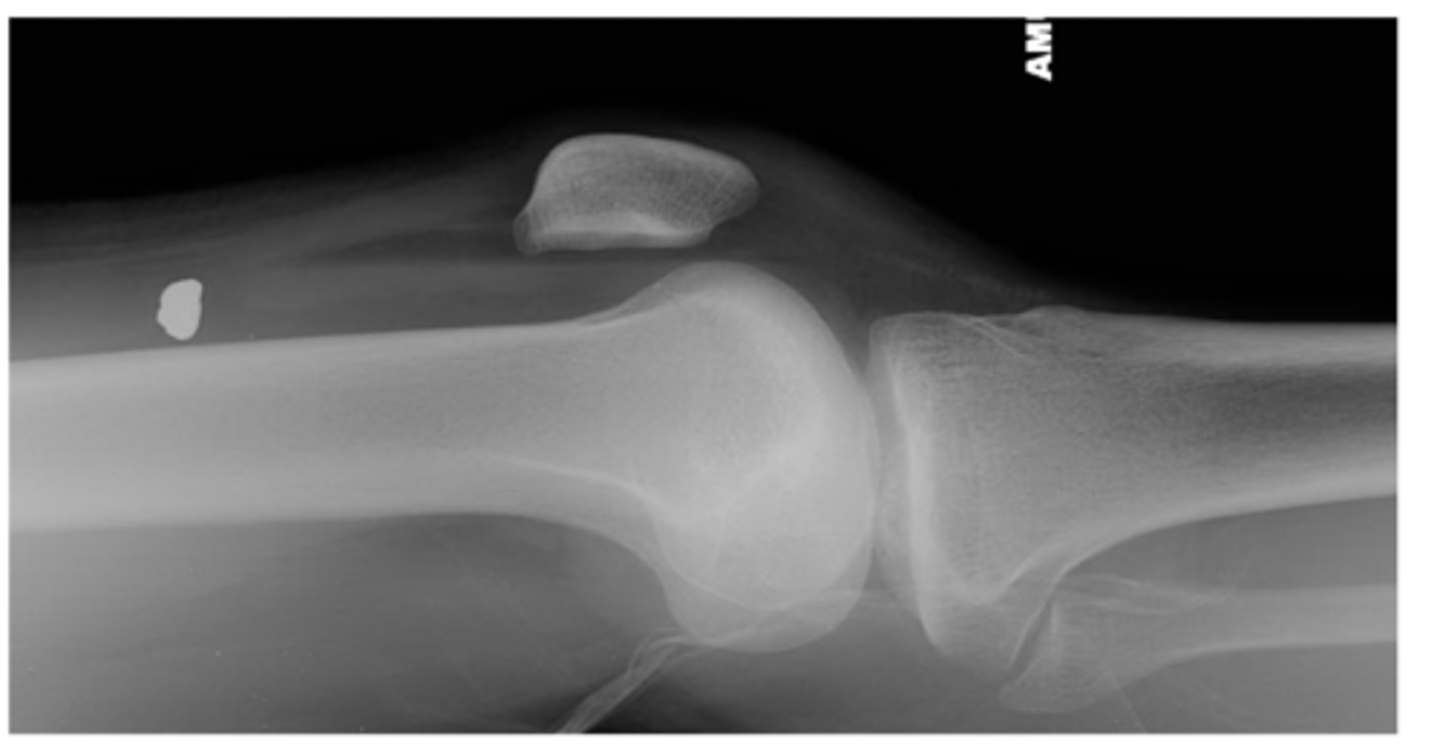 <p>Radiolucent joint recess due to joint swelling (i.e., effusion) that pushes the proximal superior recess out</p>