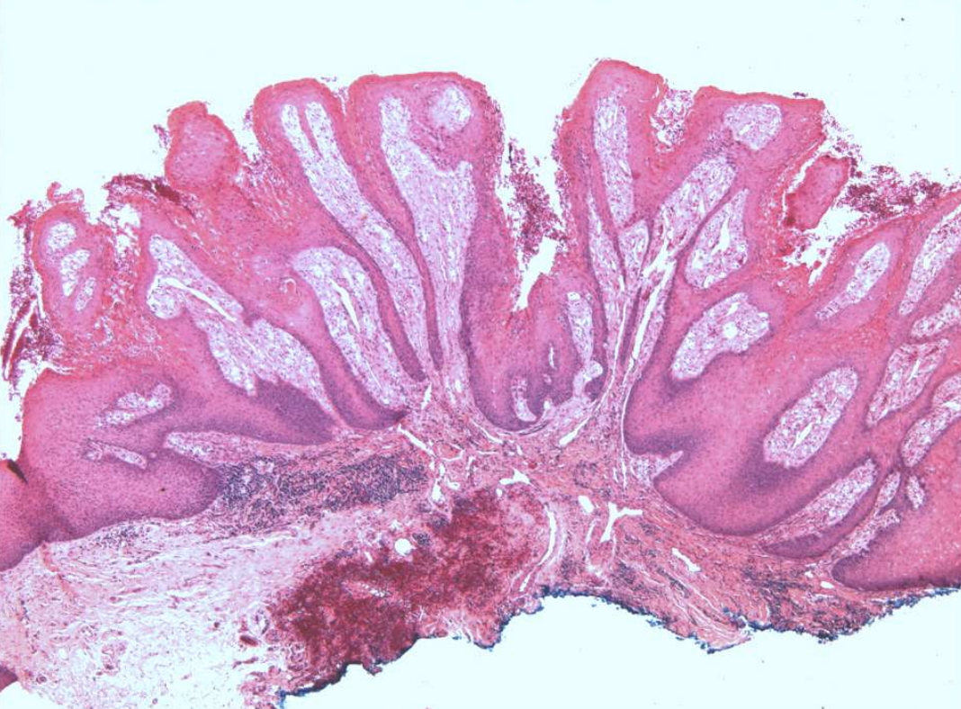<p>what are histopathologic features of Verruciform Xanthoma?</p>