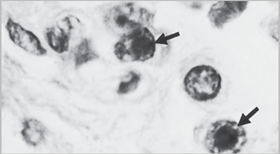 <ul><li><p><strong>Naked, ds linear, Icosahedral virus with its own DNA-dependent-DNA polymerase</strong></p></li><li><p><mark data-color="blue">Attributes: </mark></p><ul><li><p>&gt; 60 serotype, 7 subgroups (A-G)</p></li><li><p>3 vaccines for military against serotypes 4,7, delivered in a coated capsule</p></li><li><p>Transmission via respiratory droplets, fecal oral route, direct contact, fomites and cervical secretions during birth</p></li></ul></li><li><p><mark data-color="red">Pathogenesis: </mark></p><ul><li><p>Replicates in dividing epithelial cells and kills</p></li><li><p>Immune evasion-interfere with MHC/peptide surface expression which results in decreased T cell recognition</p></li><li><p><em><u>Immunocompromised</u></em></p><ul><li><p>more severe disease</p></li><li><p>Viremia spreads to kidneys, bladder, lymphatic system and causes inflammation</p></li><li><p>Pneumonia</p><ul><li><p>Can remain in lymph nodes for 6-18 months</p><p>Shed virus (even if carrier is not overtly sick) </p></li></ul></li></ul></li></ul></li><li><p><mark data-color="purple">Clinical Presentation: </mark></p><ul><li><p><strong><u>Accounts for 10% of acute febrile illness in the under 2 population</u></strong></p></li><li><p>Acute Respiratory Distress (ARDs) in military recruits</p></li></ul></li><li><p><mark data-color="yellow">Diseases:</mark></p><ul><li><p><strong>Exudative pharyngitis</strong></p><ul><li><p>Occasionally progresses to pneumonia or Acute Respiratory Disease</p></li><li><p>In late winter, spring</p></li><li><p><mark data-color="purple">#1 cause of infectious conjunctivitis</mark></p><p><mark data-color="purple">swimmer’s conjunctivitis from improperly maintained pools</mark></p></li></ul></li><li><p><strong>#2 cause of diarrhea/gastroenteritis in kids</strong></p><p>Watery, non-bloody diarrhea, nausea, vomiting, cramps</p><ul><li><p><mark data-color="purple">Summer</mark></p></li><li><p><mark data-color="purple">Daycares</mark></p></li></ul></li></ul></li><li><p><mark data-color="green">Diagnosis </mark></p><ul><li><p>PCR or cell culture followed by Ab testing for epidemiology purposes</p><p></p><p></p><p></p></li></ul></li></ul>