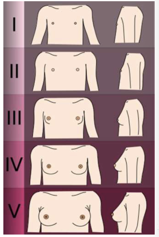 <ul><li><p>Stage 1: pre adolescent - elevation of nipple only </p></li><li><p>Stage 2: breast bud stage - elevation of breast and nipple as a small mound; enlargement of areolar diameter </p></li><li><p>Stage 3: further enlargement of elevation of breast and areola </p></li><li><p>Stage 4: projection of areola and nipple to form a secondary mound above the level of breast/chest </p></li><li><p>Stage 5: mature stage, projection of nipple only. Areola has receded to general contour of the breast/chest </p></li></ul><p></p>
